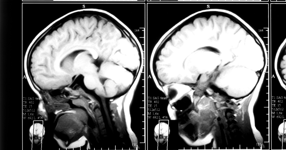 Image illustrating potential traumatic brain injury from an auto accident.